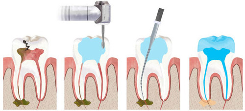stages of root canal treatment