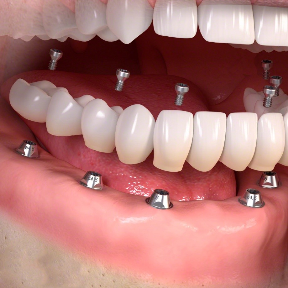 dental implant retained full arch bridge