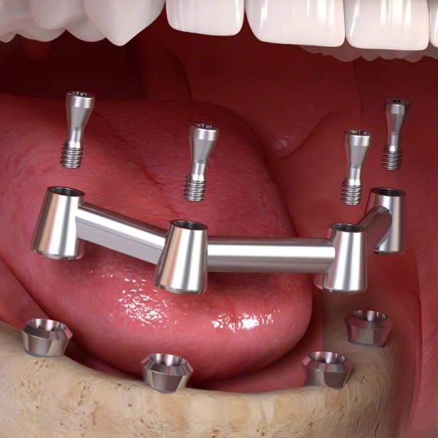 substructure for dental implant retained denture
