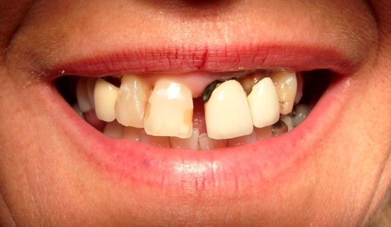 smile design cosmetic dentistry