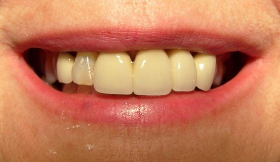 smile design cosmetic dentistry